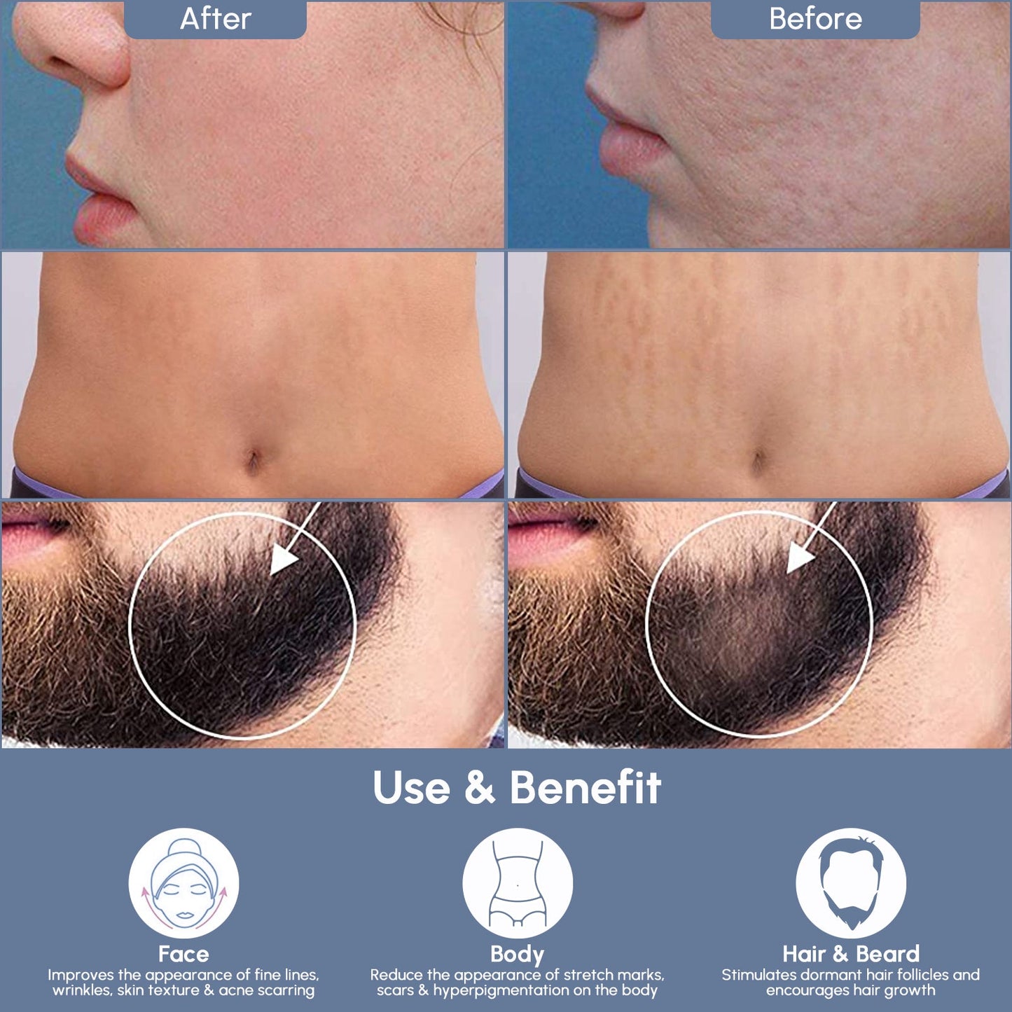 Stylo à aiguilles réglables en titane pour micro-aiguilles Derma